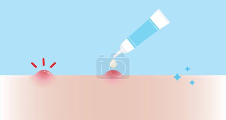 Illustration for How to use acne pimple treatment for papule vector illustration on sky blue background. Step of use, direction for use acne cream, gel and lotion absorbing inflammatory acne on skin face. Skin care and beauty concept. - Royalty Free Image