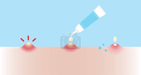 Illustration for Direction for use acne pimple treatment for pustule vector illustration on sky blue background. How to use, step for use acne cream, gel and lotion absorbing inflammatory acne on skin face. Skin care and beauty concept. - Royalty Free Image