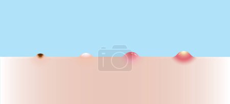 Illustration for Types of acne vector set illustration isolated on sky blue background. Formation of acne, blackhead, whitehead, papule and pustule. Flat design vector acne illustration. Skin care and beauty concept. - Royalty Free Image