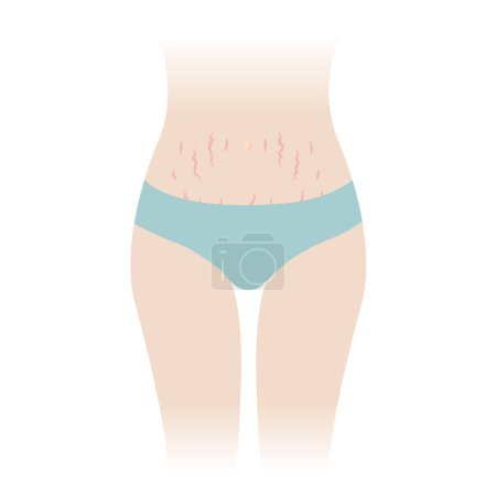 Illustration for Red stretch marks on tummy vector illustration isolated on white background. The striae rubrae appear on the abdomen, mid stomach, belly front of woman body. Skin care and beauty concept. - Royalty Free Image