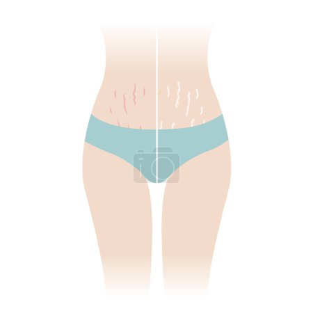 Illustration for Comparison of red and white stretch marks on tummy vector illustration isolated on white background. The striae rubrae and striae albae appear on the abdomen, mid stomach, belly front of woman body. Skin care and beauty concept. - Royalty Free Image