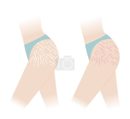 Illustration for Comparison of red and white stretch marks on hip and thigh vector illustration isolated on white background. The striae rubrae and striae albae appear on the hip and thigh side of woman body. Skin care and beauty concept. - Royalty Free Image