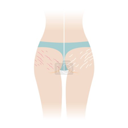 Téléchargez les illustrations : Comparison of red and white stretch marks on buttocks vector illustration isolated on white background. The striae rubrae and striae albae appear on the bottom, hip, ass back of woman body. Skin care and beauty concept. - en licence libre de droit