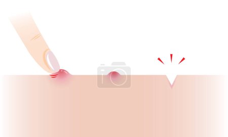 Illustration for Step of popping pimple to icepick scar vector illustration on white background. The inflammatory acne, papule on skin, squeezing pimple with finger to acne scar. Before and after skin care and beauty concept. - Royalty Free Image