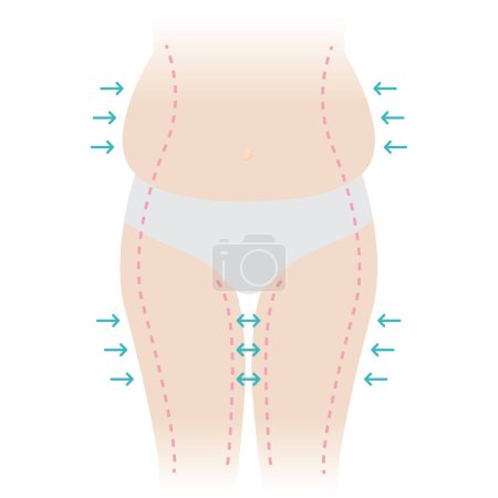 Illustration for Woman body fat vector illustration isolated on white background. The woman fat belly, hip and thigh with arrows, dotted lines marks on skin. Weight, liposuction, cellulite removal, skin lifting editable concept. - Royalty Free Image