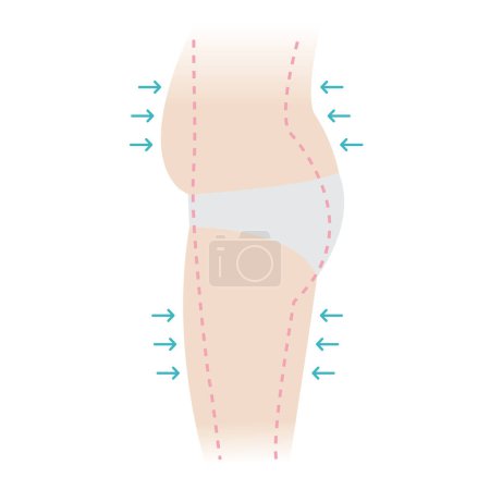 Illustration for Side of the woman fat belly, hip and thigh with arrows, dotted lines marks vector illustration isolated on white background. Overweight, liposuction, cellulite removal, skin lifting concept. - Royalty Free Image