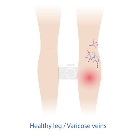 Comparaison des veines saines et des varices sur l'illustration vectorielle des jambes de la femme isolée sur fond blanc. Les varices et les araignées sont gonflées, tordues et douloureuses, ce qui les fait apparaître sous la peau..