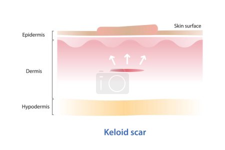 Keloid-Narbe auf der Hautoberfläche Vektor Illustration isoliert auf weißem Hintergrund. Querschnitt der Keloidnarbe, die sich über die Grenzen der ursprünglichen Verletzung hinaus ausbreitet und eine Überwucherung des Narbenrandes aufweist.