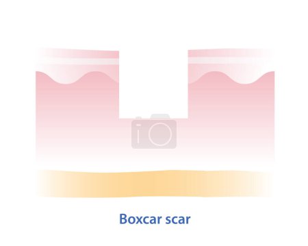Illustration for Cross section of boxcar scar vector illustration isolated on white background. Boxcar scar, atrophic scar, type of acne scar on skin surface. Skin care and beauty concept. - Royalty Free Image
