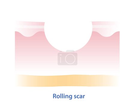 Illustration for Cross section of rolling scar vector illustration isolated on white background. Rolling scar, atrophic scar, type of acne scar on skin surface. Skin care and beauty concept. - Royalty Free Image