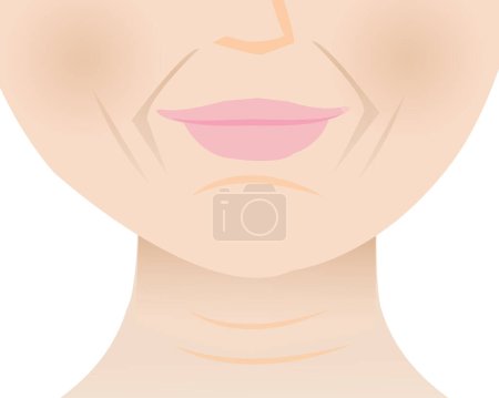 Ilustración de La cara inferior arrugada piel de la mujer madura ilustración vectorial. Líneas de marioneta, pliegues nasolabiales, líneas de sonrisa, arrugas mentales y líneas de cuello. Arrugas de envejecimiento profundo en la cara. Concepto de problema cutáneo. - Imagen libre de derechos