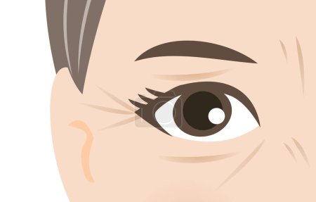 Illustration for Crown feet and Tear troughs on skin around the eye of mature woman vector illustration. The deep aging eye wrinkles on middle face, periocular or periorbital skin, Frown lines and Bunny lines. Skin problem concept. - Royalty Free Image