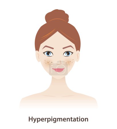 Illustration for Hyperpigmentation, melasma, dark spots on woman face vector on white background. Skin pigment discoloration, darkened pigment, abnormally high amount of melanin. Skin pigment disorders concept. - Royalty Free Image