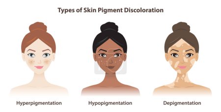 Types of skin pigment discoloration vector isolated on white background. Hyperpigmentation, darkened pigment. Hypopigmentation, lightened pigment. Depigmentation, loss of pigment. Skin pigment disorders concept.