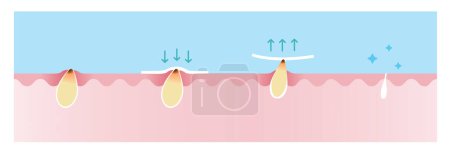 Illustration for Step of blackhead removal vector illustration on blue sky background. Cross section of blackhead pore strip treatment, apply, peel off, unclogging and tighten pore. Skin care and beauty concept. - Royalty Free Image