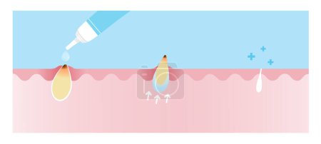 Illustration for Direction for use blackhead treatment gel vector illustration on sky blue background. Cross section of use acne cream, reduce clogged pore, non inflammatory acne and tighten pore. Skin care and beauty concept. - Royalty Free Image