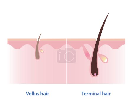 The difference between vellus hair and terminal hair vector illustration isolated on white background. Hair Types. Vellus hair is fine, wispy and unpigmented hair. Terminal hair is thick, coarse, long and pigmented hair.