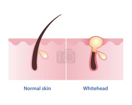 Ilustración normal del vector de acné de piel y cabeza blanca aislada sobre fondo blanco. Whitehead, tipo de grano no inflamatorio. Cerrado comedone. Cuidado de la piel y concepto de belleza.