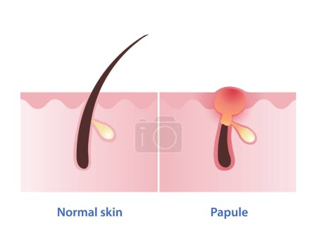 Papule, type of inflammatory acne vector isolated on white background. Cross section of normal skin and papule pimple is small, solid, red, inflamed bump in skin layer. Skin care concept illustration.