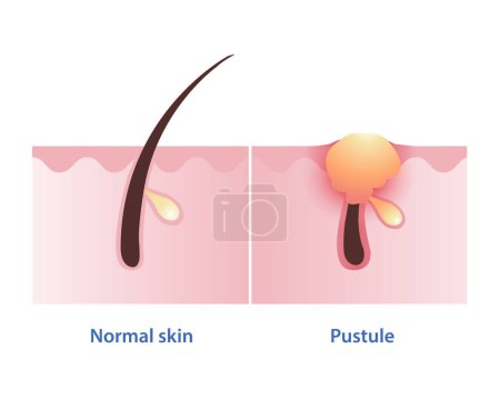 Pustule, tipo de acné inflamatorio se desarrollan a partir de vector pápula sobre fondo blanco. La comparación de la piel normal y la espinilla de la pústula es pequeña, inflamada, llena de pus, como ampollas en la superficie de la piel.