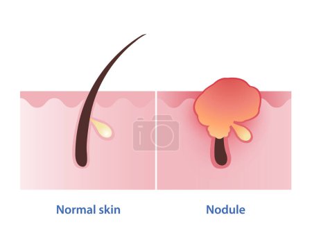 Nodule, type of inflammatory acne vector on white background. Normal skin and nodular acne is firm, painful lump to form under your skin and red bump is inflamed to appear on the skin surface.