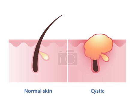 Illustration for Cystic acne, the most severe type of inflammatory acne vector on white background. Normal skin and cyst develop pus filled pimple deep under the skin, often painful, large and to cause scarring. - Royalty Free Image