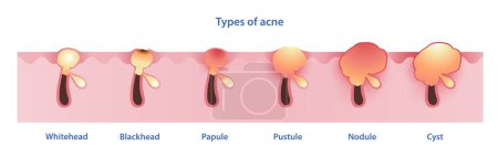 Types of acne vector on white background. Formation of noninflammatory acne, whitehead, blackhead, inflammatory acne, papule, pustule, nodule and cyst. Skin care and beauty concept illustration.