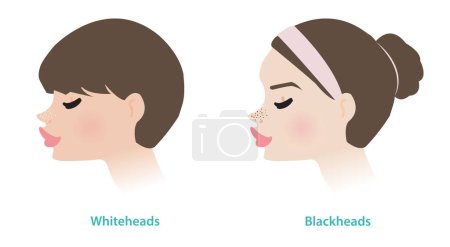 Mujeres lindas con Whiteheads y blackheads acné en la nariz ilustración vectorial. Whiteheads y blackheads son ambos tipos de acné no inflamatorio, son formas de comedones. El poro está cerrado o abierto.