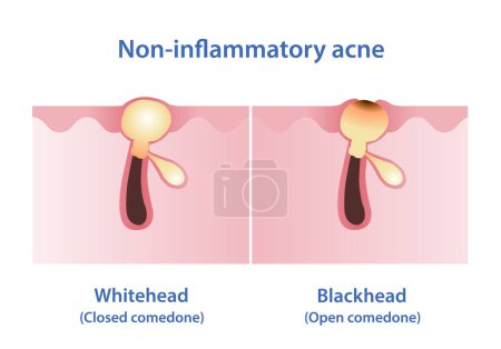 Illustration for The difference between whitehead and blackhead acne vector illustration. Whitehead and blackhead are both types of non inflammatory acne, they are forms of comedones. The pore is closed or open. - Royalty Free Image