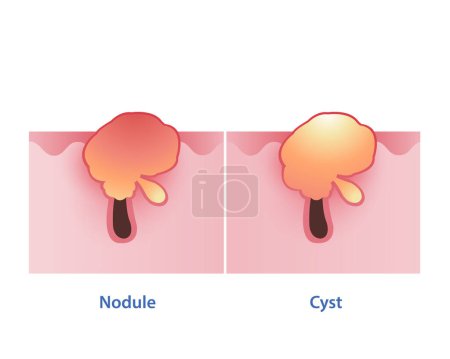 The difference between nodule and cyst vector on white background. Nodular is firm, painful, red bump on the surface skin. Cystic acne consist of deep, pus filled. The both are inflammatory severe.
