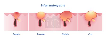 Illustration for Diagram of inflammatory acne types vector illustration isolated on white background. Papule, pustule, nodule, nodular, nodulocystic, cystic acne and cyst. Skin care and beauty concept. - Royalty Free Image