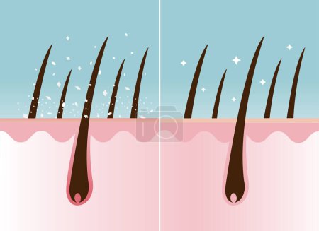 Comparación de la caspa en el cabello y el cabello sano en la ilustración del vector de la capa del cuero cabelludo. Cabello con el cuero cabelludo escamoso seco blanco y nutrido. Cuidado del cabello y concepto de problema.