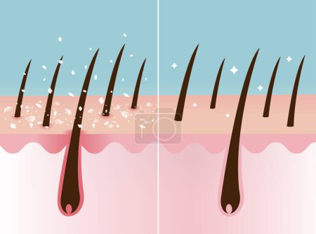 Comparaison des pellicules et des cheveux sains sur l'illustration vectorielle de la couche du cuir chevelu. Coupe transversale du cuir chevelu squameux, blanc écailles sèches dans les cheveux et les cheveux nourris. Soins capillaires et concept de problème.
