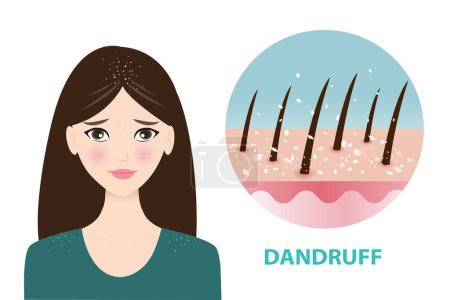 Infographic of woman and dandruff icon vector illustration. The woman is worried about white dry flakes on hair and shoulder. Icon of dandruff, scaly scalp in hair. Hair care and problem concept.