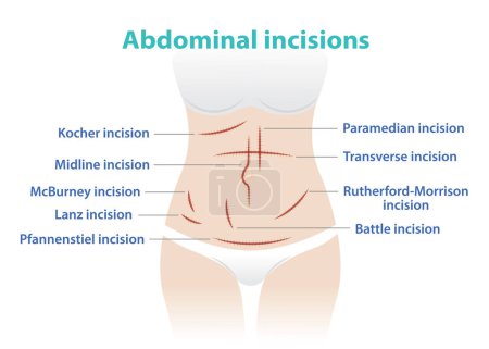 Tipos de incisión abdominal para cirugía ilustración vectorial aislada sobre fondo blanco. Kocher, Midline, McBurney, Lanz, Pfannenstiel, Paramedian, Transverse, Rutherford Morrison, Battle incision.