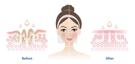 Der Vergleich des weiblichen Gesichts vor und nach der Hautpflege verringert den Faltenvektor. Querschnitt der Falten Haut und Hautpflege absorbierend, um die Hautalterung und geschädigte Haut zu reduzieren. Hautpflege und Schönheitskonzept.