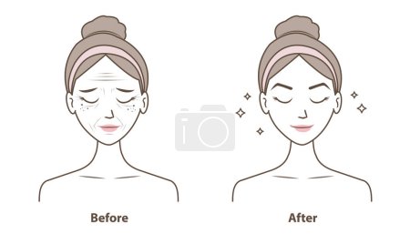 Illustration for Before and after wrinkles on woman face vector illustration isolated on white background. Comparison of aging, damaged and beauty skin in cartoon style. Skin care and beauty concept. - Royalty Free Image
