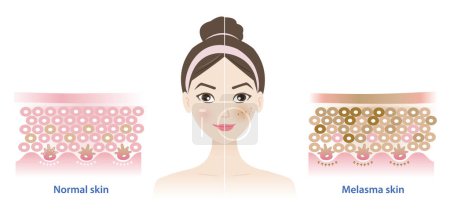 Comparación de piel normal y melasma en la ilustración del vector facial de la mujer sobre fondo blanco. Diagrama de la capa de piel de epidermis sana, melasma y manchas oscuras. Cuidado de la piel y concepto de belleza.