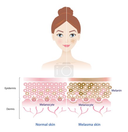 Illustration for Infographic of normal and melasma skin on woman face vector illustration. Comparison of healthy epidermis skin layer, hyperpigmentation, melasma and dark spots. Skin care and beauty concept. - Royalty Free Image