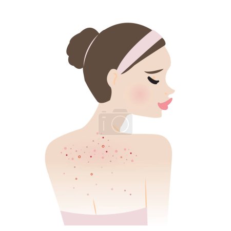 The woman with body acne vector illustration isolated on white background. Acne, pimples, blackheads, comedones, whiteheads, papule, pustule, nodule and cyst on back. Skin care and beauty concept.
