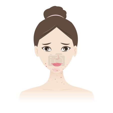 The woman with acne on jawline and neck vector illustration isolated on white background. Acne, pimples, blackheads, comedones, whiteheads, papule, pustule, nodule, cyst on face and neck. Skin problem concept.