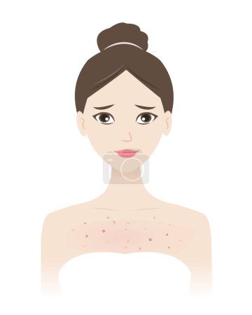 Illustration for The woman with acne on chest vector illustration isolated on white background. Acne, pimples, blackheads, comedones, whiteheads, papule, pustule, nodule and cyst on body. Skin problem concept. - Royalty Free Image