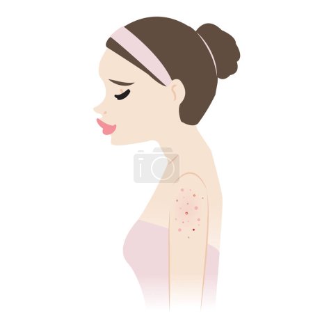Illustration for The woman with acne on upper arms vector illustration isolated on white background. Acne, pimples, blackheads, comedones, whiteheads, papule, pustule, nodule and cyst on arm. Skin problem concept. - Royalty Free Image