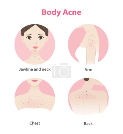 Illustration for Acne on face and body woman vector icon set on white background. Pimples, blackheads, comedones, whiteheads, papule, pustule, nodule, cyst on jawline, neck, arm, chest and back. Skin problem concept. - Royalty Free Image