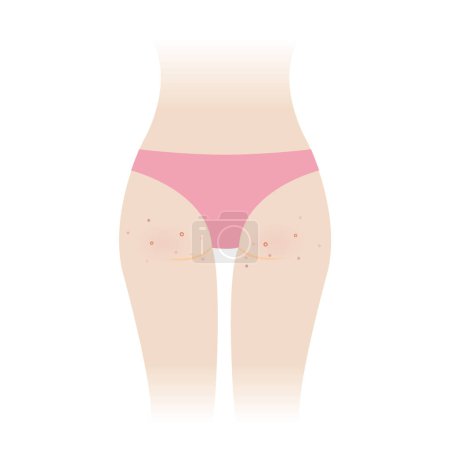 Illustration for Acne on woman buttocks vector illustration isolated on white background. Pimples, comedone, papule, pustule, nodule and cyst on the bottom, hip, ass of woman body. Skin care and skin problem concept. - Royalty Free Image