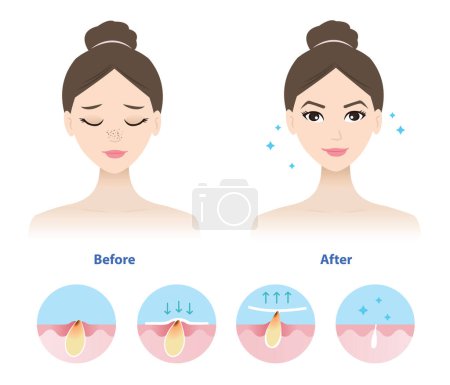 Illustration for Comparison of woman face before and after blackhead removal vector illustration isolated on white background. Icon set of blackhead treatment process, apply, peel off, unclogging and tighten pore. - Royalty Free Image