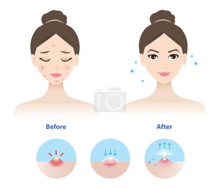 Illustration for Comparison of woman face before and after use acne pimple patch for inflammatory acne vector illustration on white background. Icon set of direction for use acne patch absorbing pustule on skin face. - Royalty Free Image
