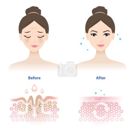 Comparison of woman face before and after wrinkle skincare absorption illustration on white background. Cross section of wrinkles skin and skincare absorbing to help reduce aging and damaged skin.