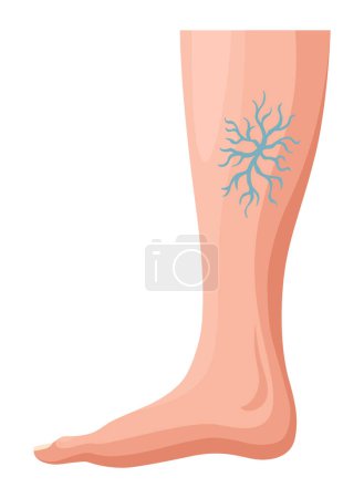 Illustration for Stages or types of varicose veins development. Medical poster or disease infographic. Image of diseased legs. Vector illustration in flat style. - Royalty Free Image