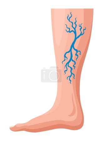 Illustration for Stages or types of varicose veins development. Medical poster or disease infographic. Image of diseased legs. Vector illustration in flat style. - Royalty Free Image